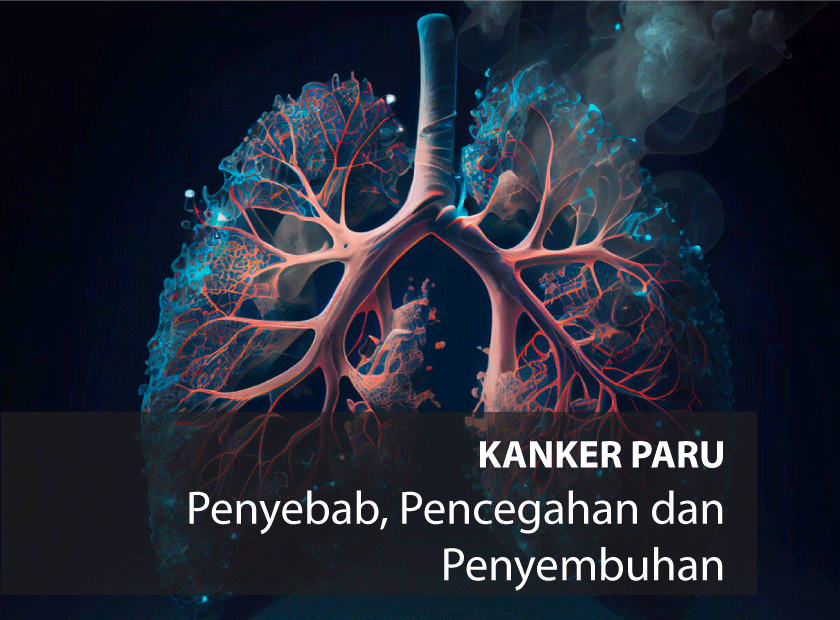 Kanker Paru-paru: Penyebab, Pencegahan Dan Penyembuhan